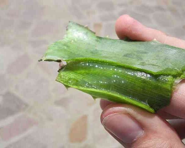 Remedios caseros para combatir las várices